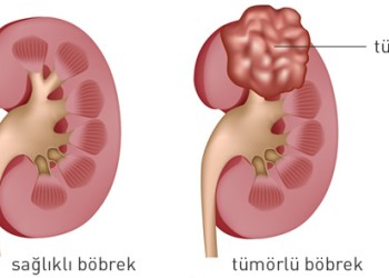 Böbrek Kanseri